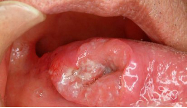 A malignant ulcer of the tongue with rolled margins in T2 stage