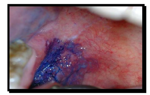 A palatal ulcer stained with toluidine blue. A biopsy confirmed an early in-situ carcinoma