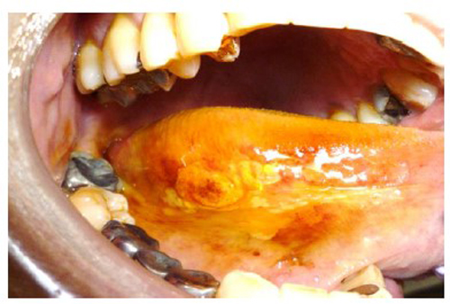 Lugol’s iodine used to demarcate margins of a tongue carcinoma.