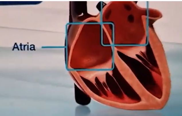 Is chronic inflammation the cause of coronary heart disease? By Dr harold Gunatillake