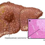 liver disease
