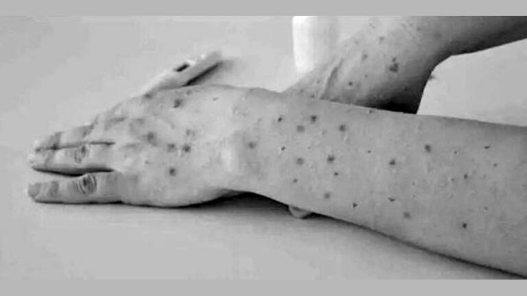 Tomato Fever is misleading name for Hand, Foot and Mouth Disease, say doctors