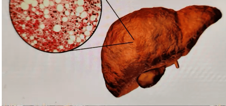 Why do doctors do Liver Function Tests?- By Dr harold Gunatillake