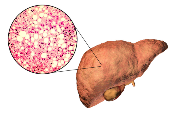 Fatty Liver Disease – By  Dr harold Gunatillake