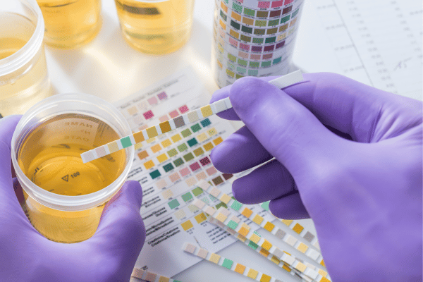 Glycosuria- a condition passing too much glucose in your urine. How does it harm you - eLanka