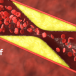 hardening of arteries