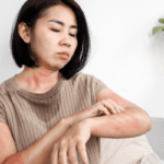 eczema