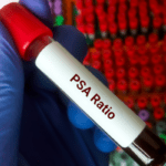 Prostatic Specific Antigen blood test