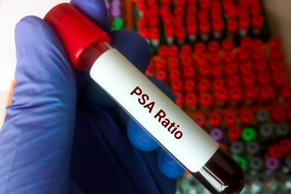 Prostatic Specific Antigen blood test
