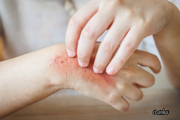 The Impact of Fungus on the Human Body: Causes, Effects, and Prevention - By Bhanuka - eLanka
